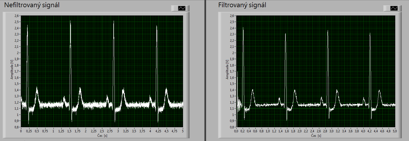 128Hz ve filtrovaném spektru jsou utlumeny všechny další frekvence, tedy rušení signálu v podobě myopotenciálů.