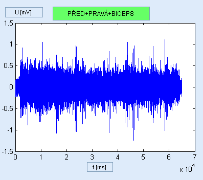 Obr. 8.3 Ukázka EMG signálu při načtení z databáze (poţadavky: pravá+biceps) 8.