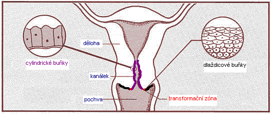 Karcinom děložního hrdla celosvětově druhé nejčastější onkologické onemocnění u žen v České republice je ročně diagnostikováno přes 1000 nových případů a přibližně 400 jich ročně umírá