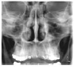 PROGRAMY 4xCRS Anatomic Automatický, 4 příčné řezy s anatomickými úhly. Pamatujte, že musíte navolit parametry snímku tak, že všechny čtyři řezy se vejdou do zvolené strany čelisti.