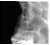 PROGRAMY 3x Lateral Sinus & Nasal (Tomografia) Automatický, 3 podélné úzké řezy oblasti sinus/midsagitální roviny (nosní dutina). V tomto programu je zvolená pozice snímek číslo 2.