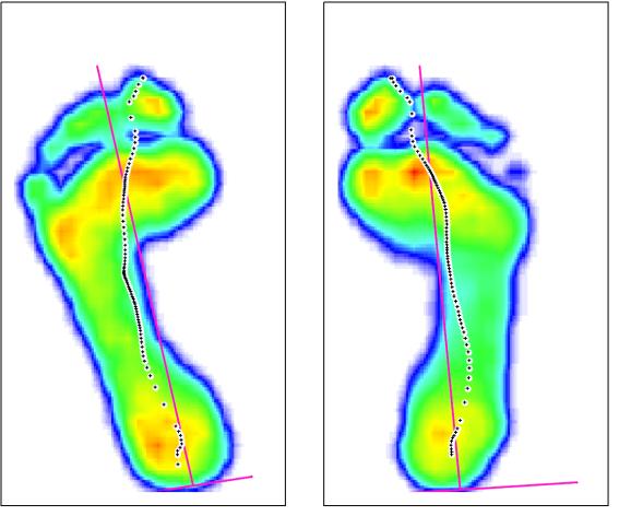 B. Vyšetření chůze pomocí přístroje Footscan Před terapií Po terapii Těţiště má stejný průběh před i po terapii.