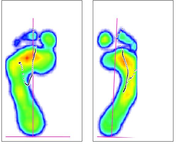 Před terapií B. Vyšetření chůze pomocí přístroje footscan Po terapii Průběh těţiště se soustřeďuje pod hlavičky metatarsů a dostává se do oblasti palce a druhého prstu.