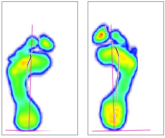 B. Vyšetření chůze pomocí přístroje Footscan Před terapií Po terapii Po terapii došlo na pravé noze k lepšímu průběhu těţiště ze střední části paty, laterálně od podélné osy nohy do oblasti palce a