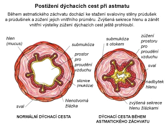 Obrázek 3. Postižení dýchacích cest při astmatu (Zdroj: Proalergiky.cz, 2011, online) 2.4.2 Klasifikace astmatu Astma lze klasifikovat podle závažnosti do čtyř stupňů: 1.