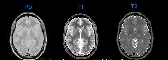 Obrázek 2: MRI mozku (PD, T1 a T2 vážený obraz) [16] 1.1.2.3 Postup při vyšetření Příprava nemocného před vyšetření není nutná.