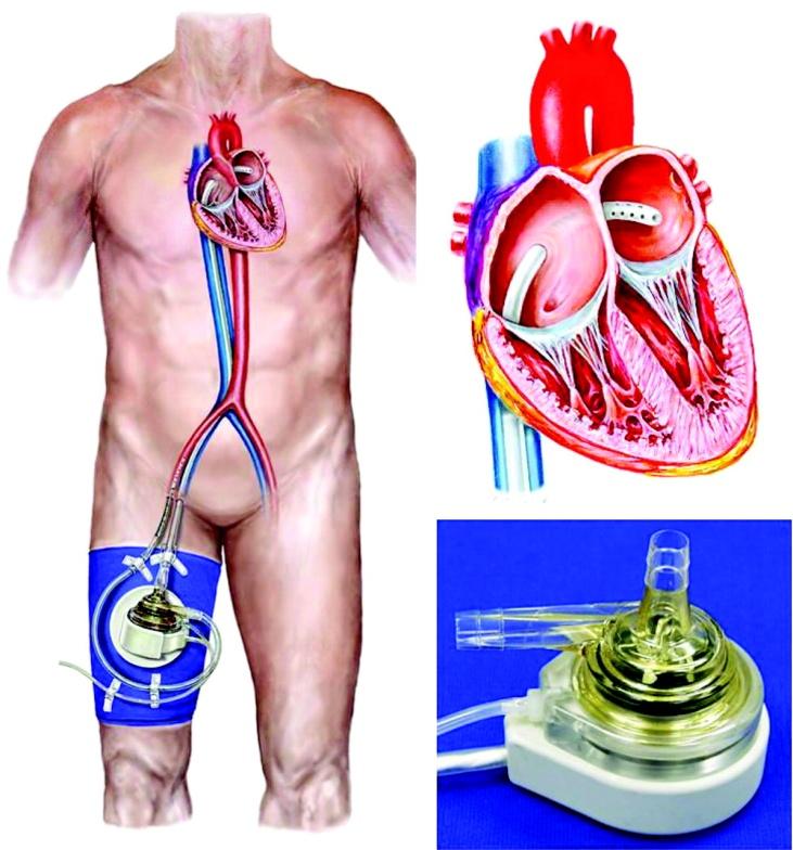 operaci. Úspěšnost této metody je zhruba 30 %. Na tomto principu pracuje i perkutánní podpora oběhu (Tandem Heart), která působí objemové odlehčení levé komory.