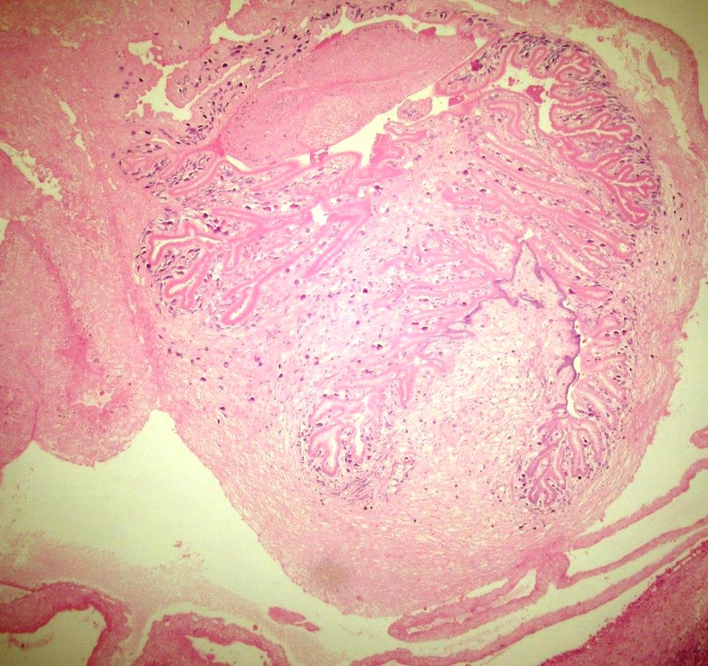 NEUROCYSTICERKÓZA Histologie c Zdroj: Atlas