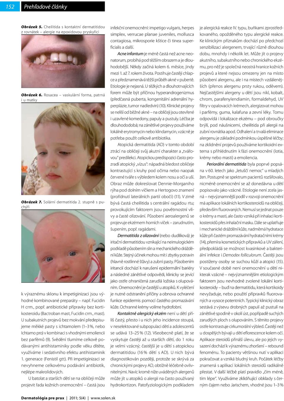 U subakutních projevů bez mokvání předepisujeme měkké pasty s ichtamolem (1 3 %, nebo Ichtamo pro) v kombinaci s vhodnými emoliencii bez parfémů (9).