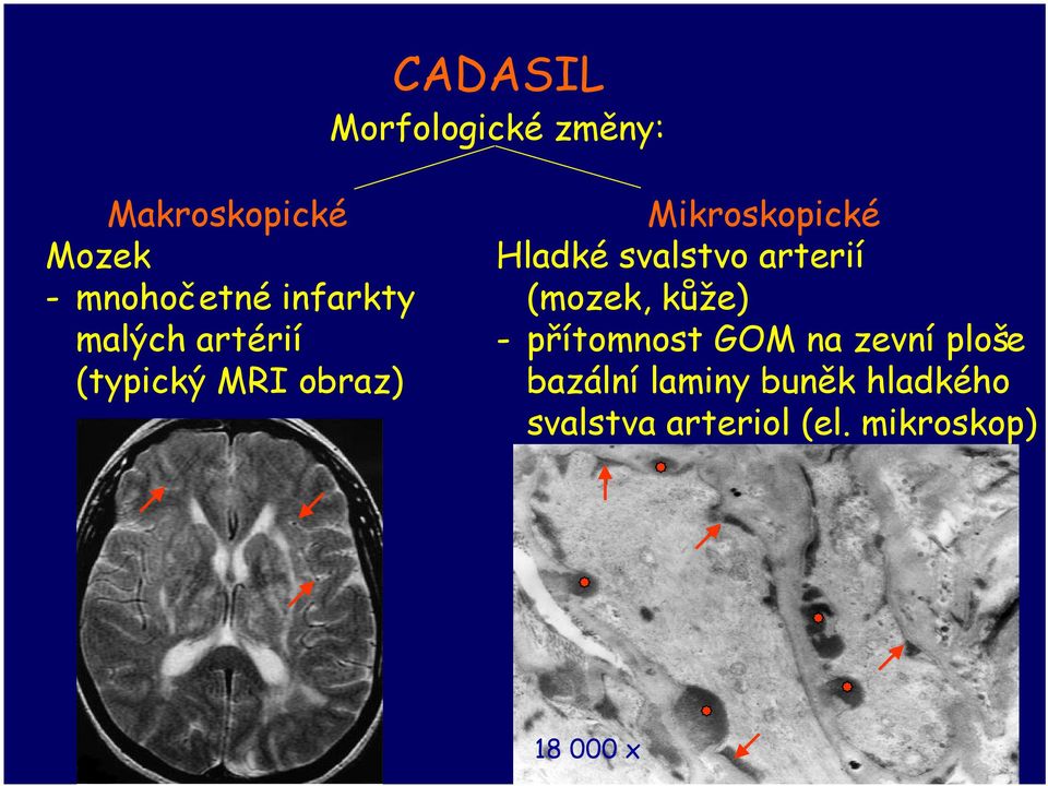 svalstvo arterií (mozek, kůže) - přítomnost GOM na zevní ploše