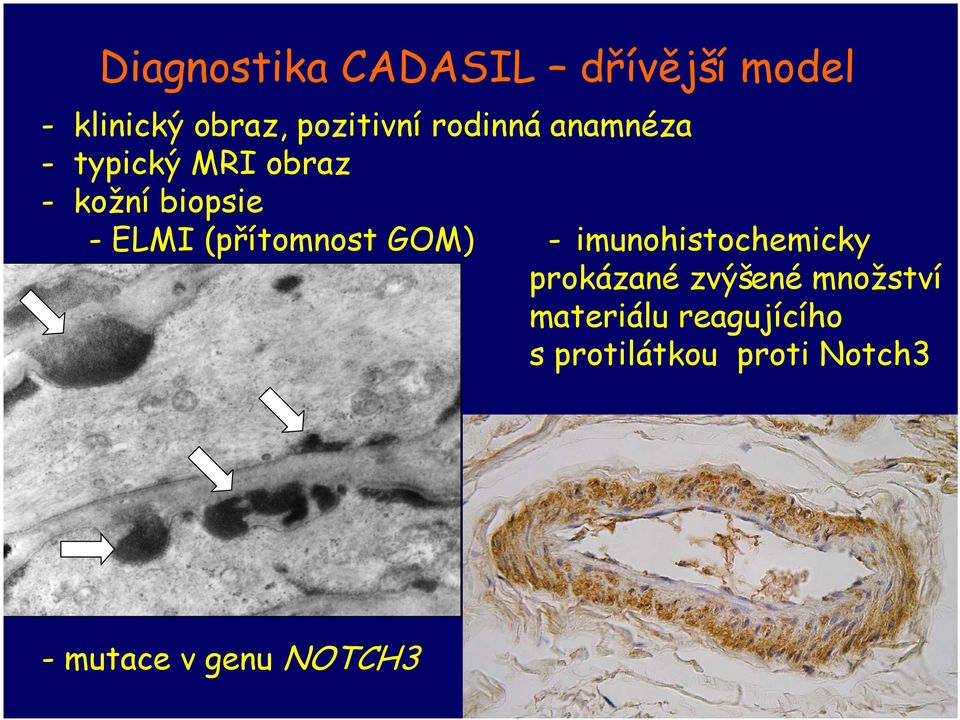 (přítomnost GOM) - imunohistochemicky prokázané zvýšené množství