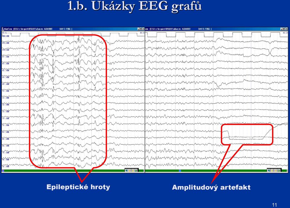 Epileptické