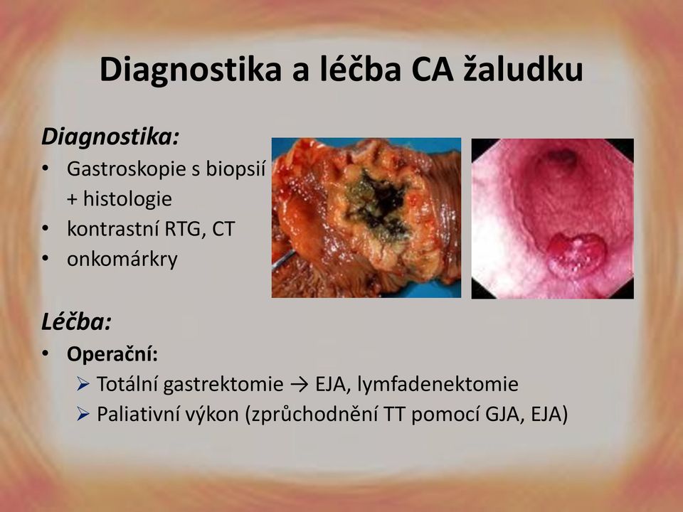 onkomárkry Léčba: Operační: Totální gastrektomie EJA,