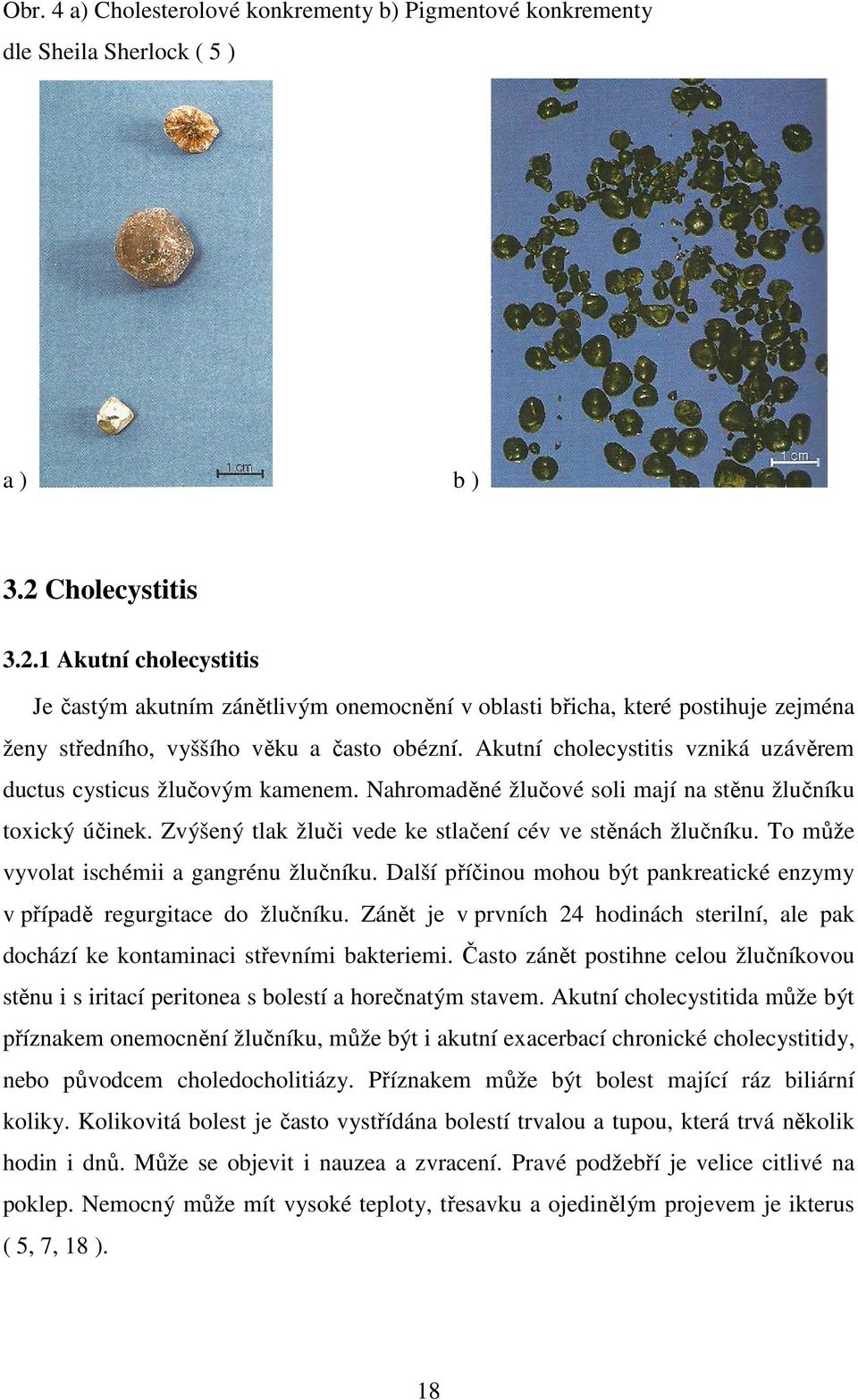 Akutní cholecystitis vzniká uzávěrem ductus cysticus žlučovým kamenem. Nahromaděné žlučové soli mají na stěnu žlučníku toxický účinek. Zvýšený tlak žluči vede ke stlačení cév ve stěnách žlučníku.