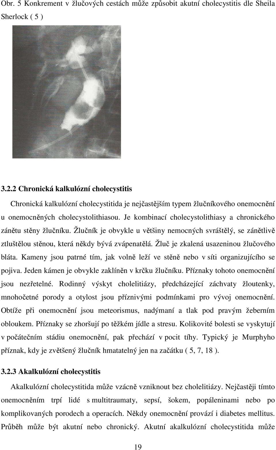 Je kombinací cholecystolithiasy a chronického zánětu stěny žlučníku. Žlučník je obvykle u většiny nemocných svráštělý, se zánětlivě ztluštělou stěnou, která někdy bývá zvápenatělá.