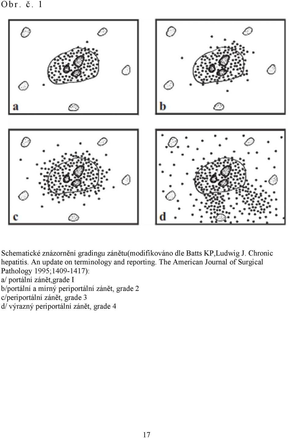 The American Journal of Surgical Pathology 995;409-47): a/ portální zánět,grade I
