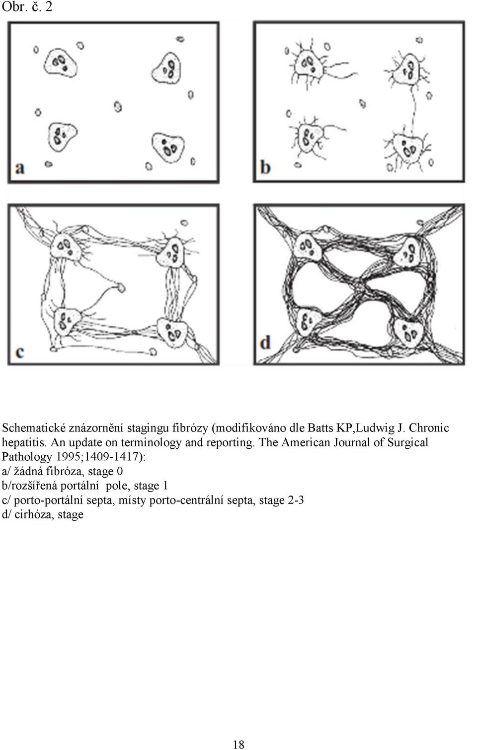 The American Journal of Surgical Pathology 995;409-47): a/ žádná fibróza, stage 0
