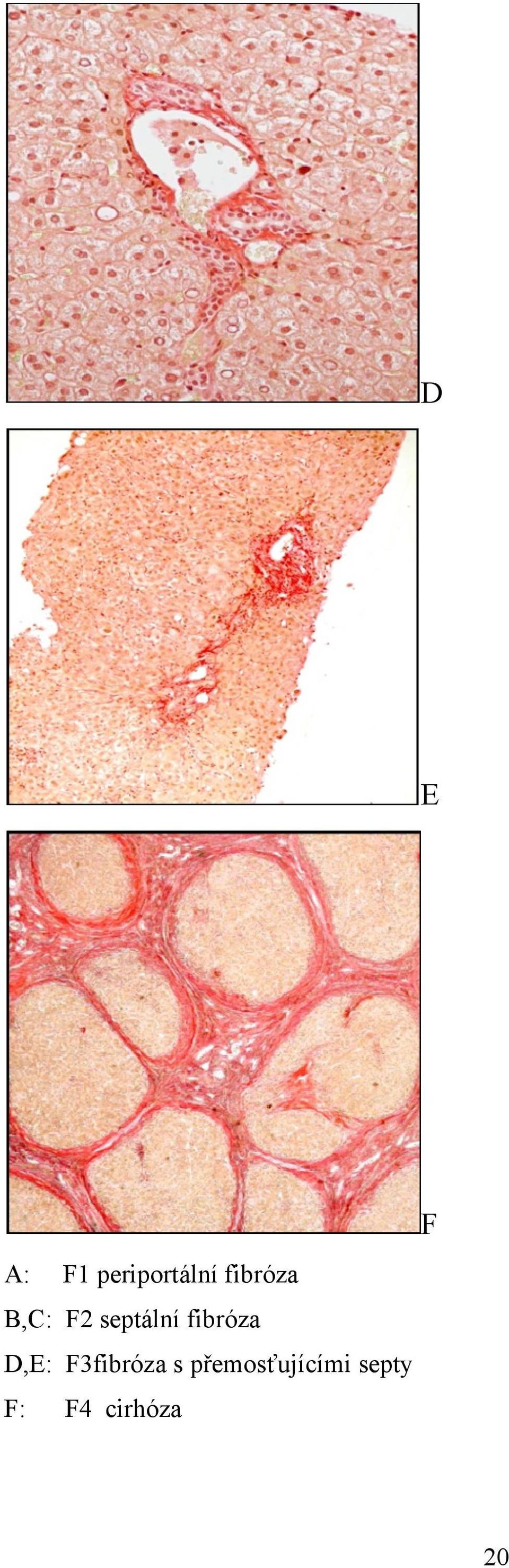 fibróza D,E: F3fibróza s