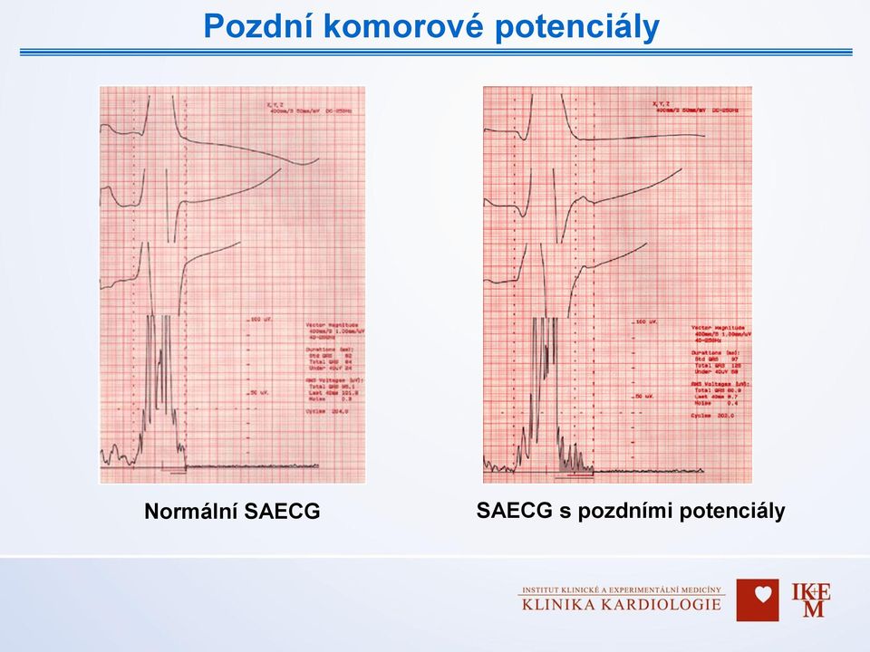 Normální SAECG