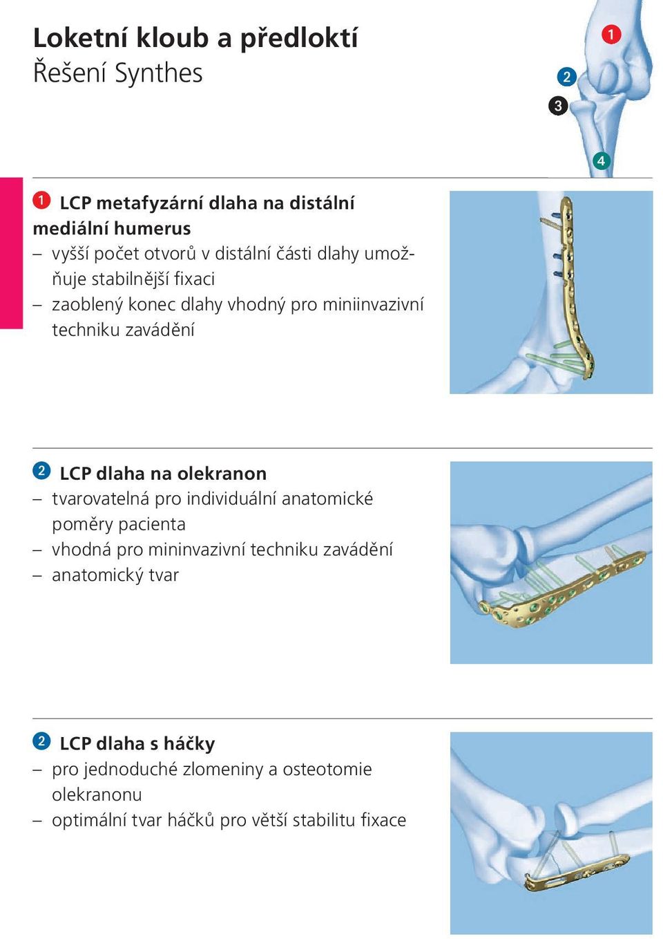 dlaha na olekranon tvarovatelná pro individuální anatomické poměry pacienta vhodná pro mininvazivní techniku zavádění