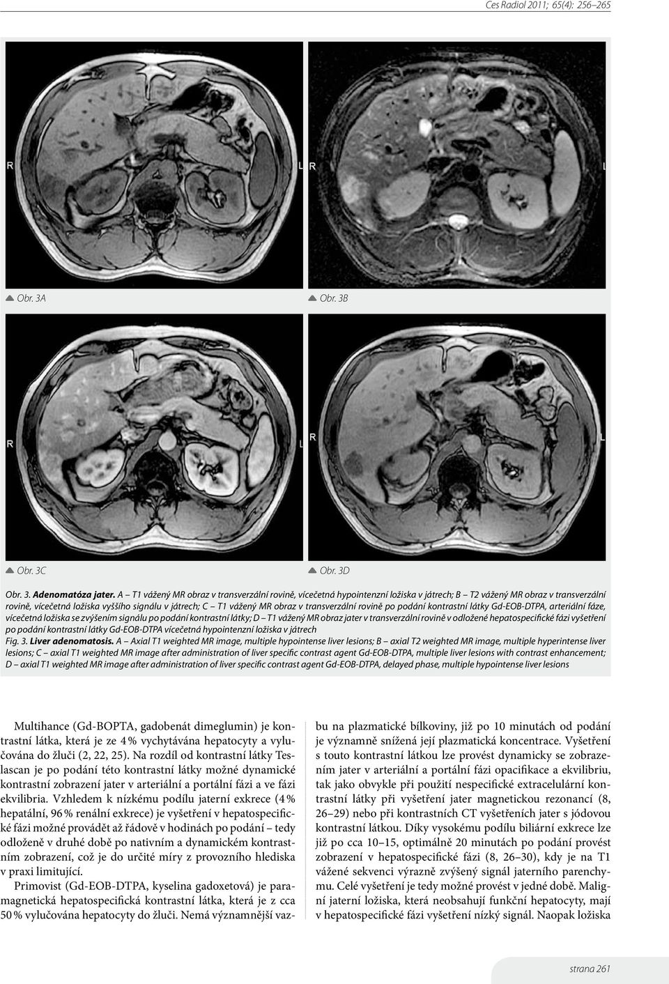 transverzální rovině po podání kontrastní látky Gd-EOB-DTPA, arteriální fáze, vícečetná ložiska se zvýšením signálu po podání kontrastní látky; D T1 vážený MR obraz jater v transverzální rovině v
