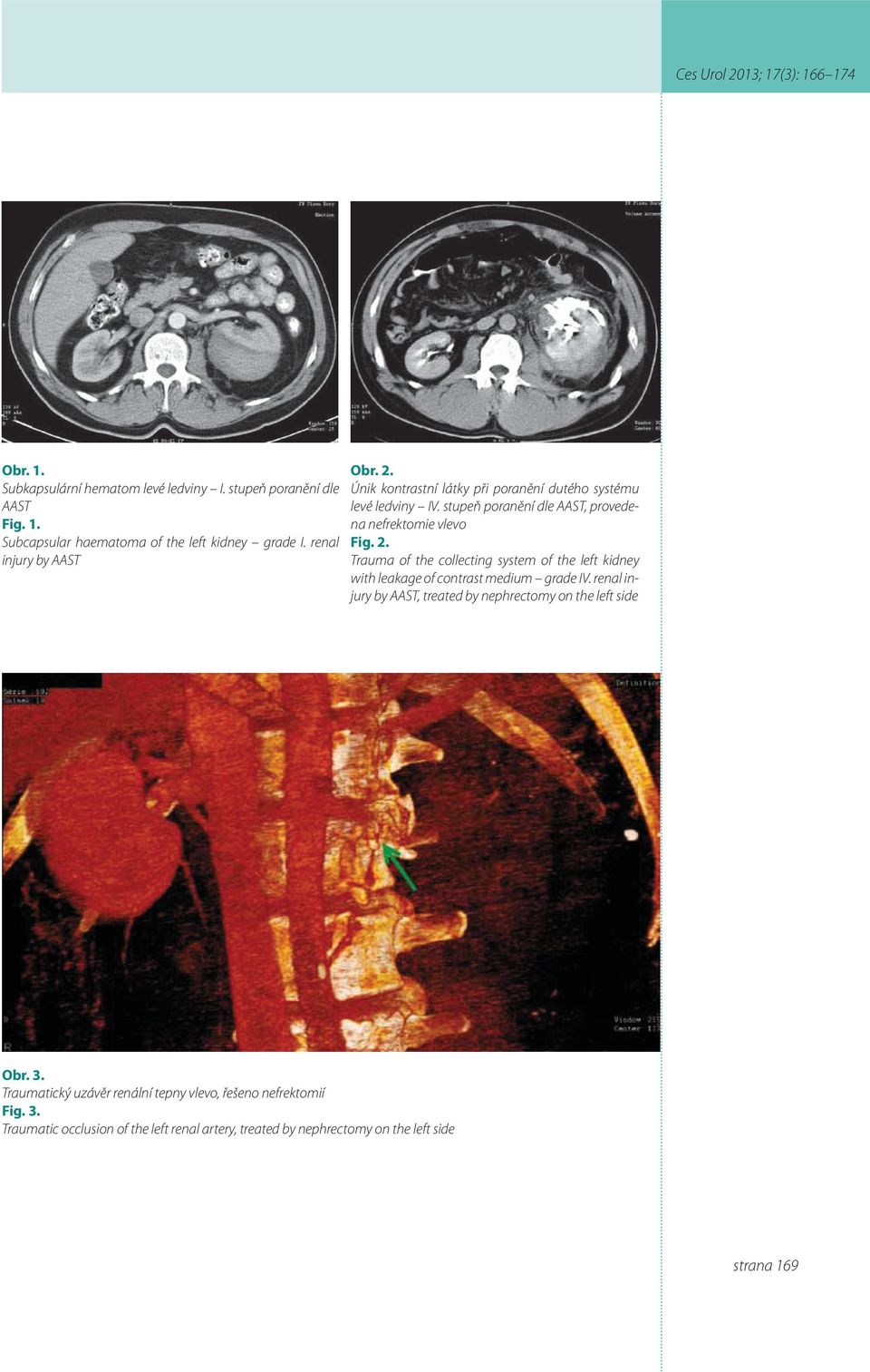 Trauma of the collecting system of the left kidney with leakage of contrast medium grade IV.