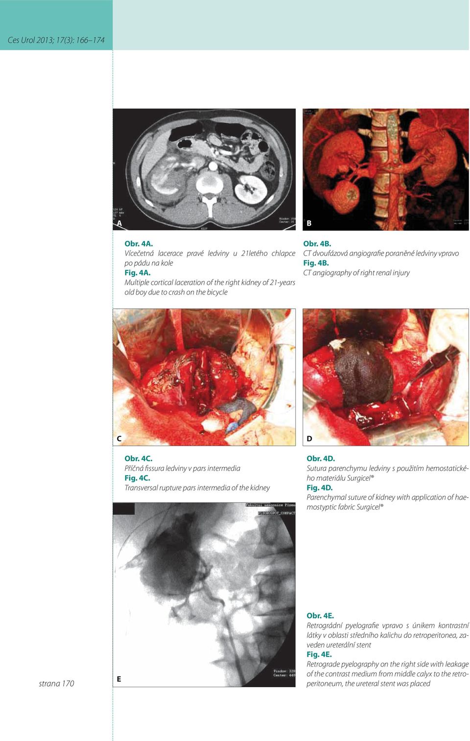 4D. Sutura parenchymu ledviny s použitím hemostatického materiálu Surgicel Fig. 4D. Parenchymal suture of kidney with application of haemostyptic fabric Surgicel strana 170 E Obr. 4E.