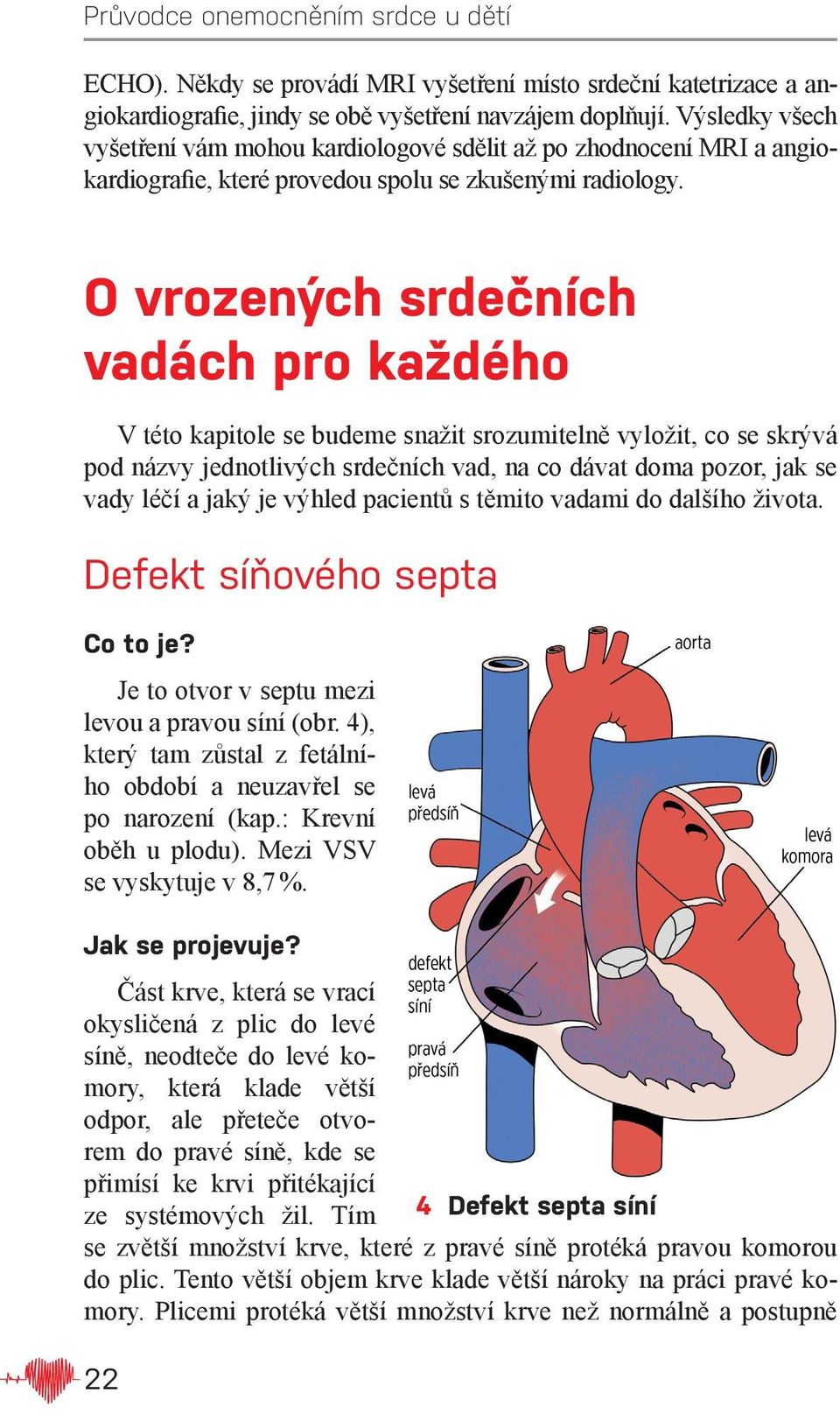 O vrozených srdečních vadách pro každého V této kapitole se budeme snažit srozumitelně vyložit, co se skrývá pod názvy jednotlivých srdečních vad, na co dávat doma pozor, jak se vady léčí a jaký je