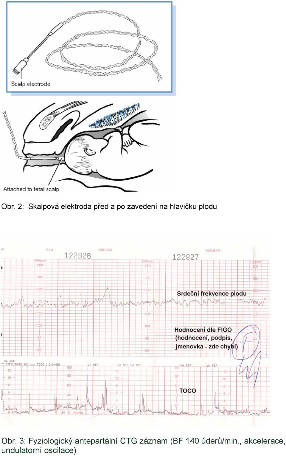 3: Fyziologický antepartální CTG záznam