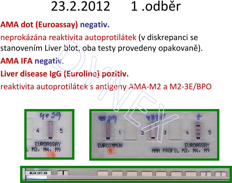Liver blot, oba testy provedeny opakovaně). AMA IFA negativ.