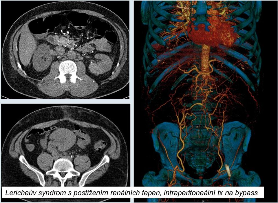 renálních tepen,