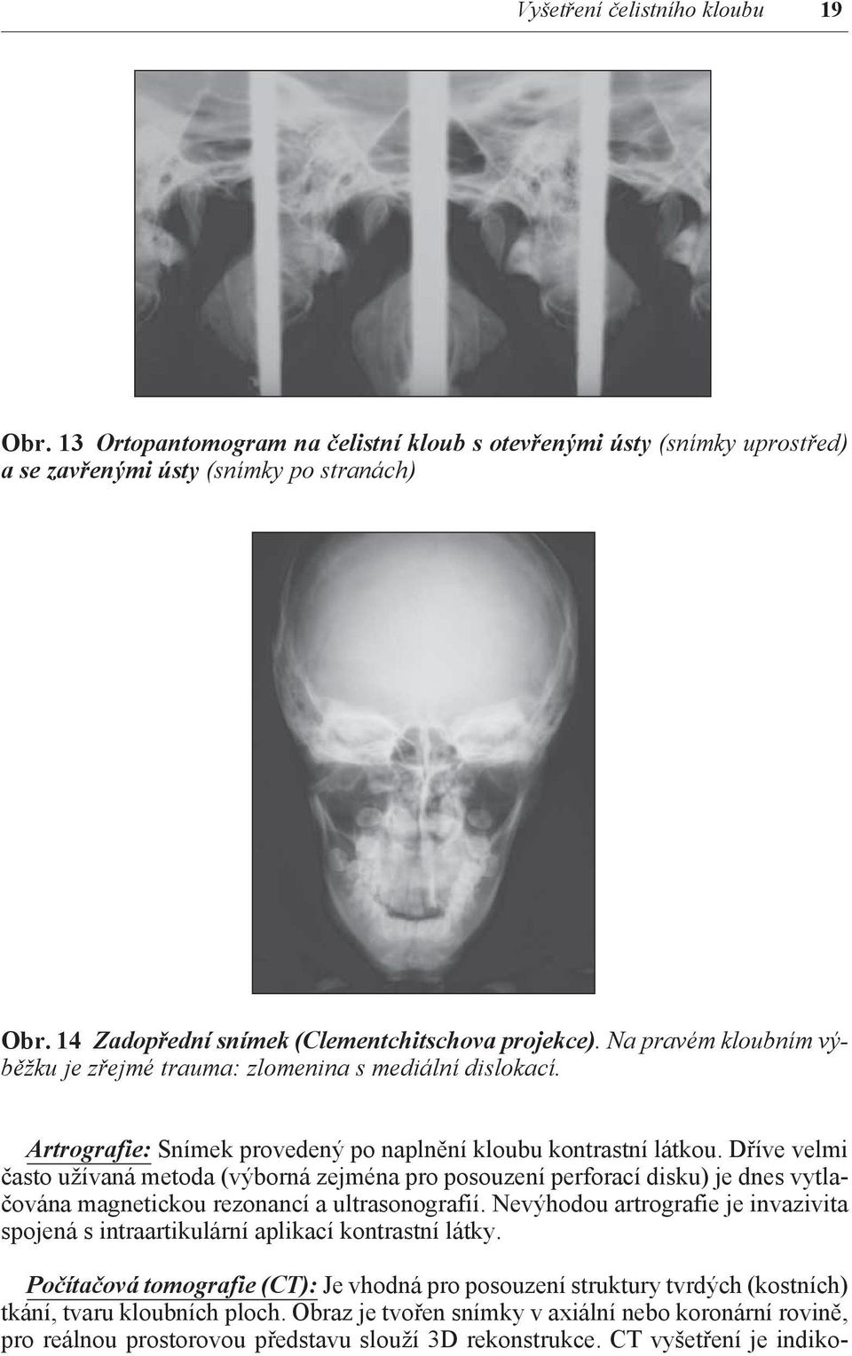 Dříve velmi často užívaná metoda (výborná zejména pro posouzení perforací disku) je dnes vytlačována magnetickou rezonancí a ultrasonografií.