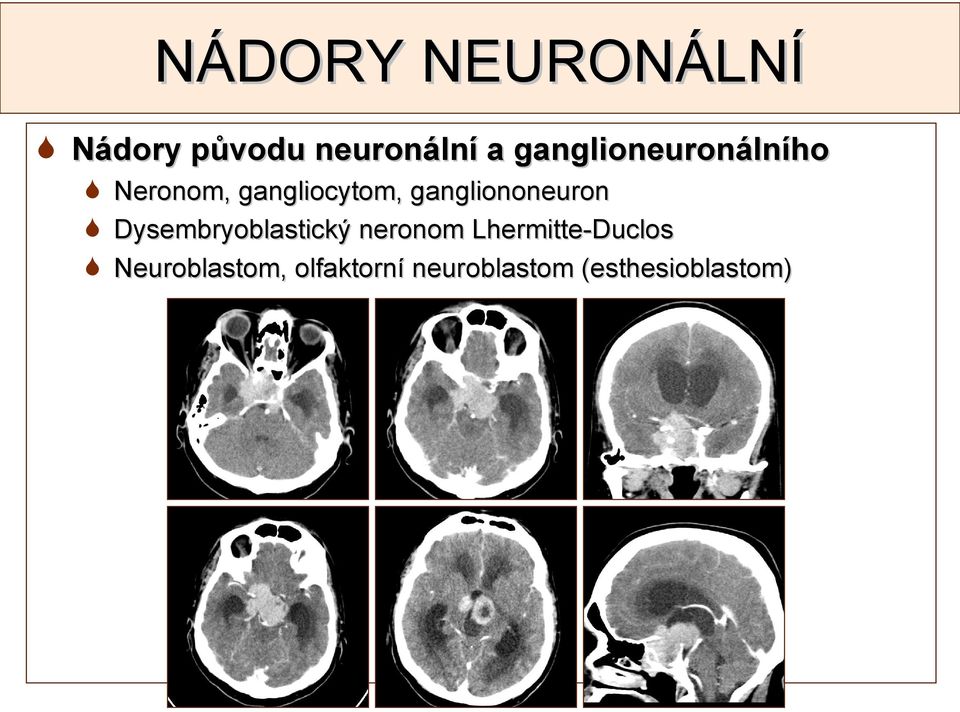 gangliononeuron Dysembryoblastický neronom