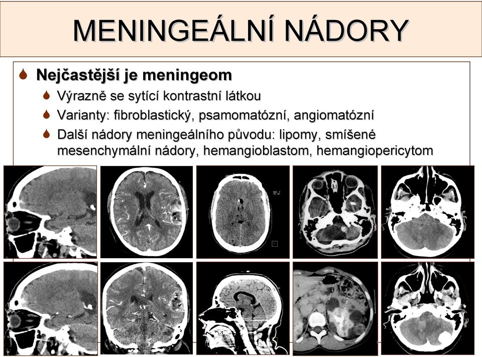 psamomatózní, angiomatózní Další nádory meningeálního