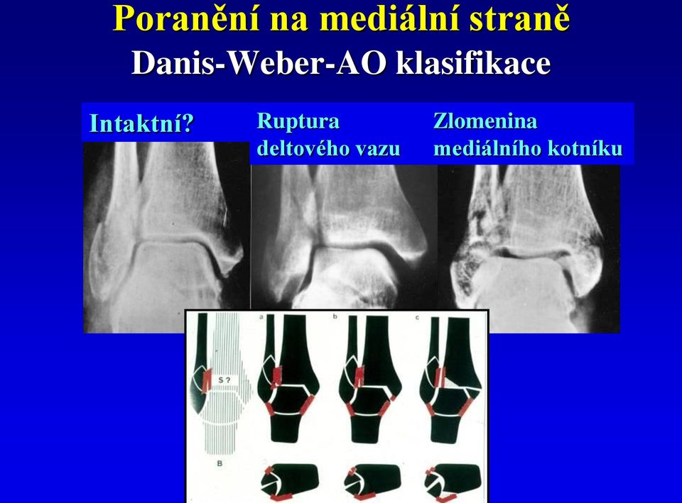 Luxační zlomeniny hlezna Nevyřešené zlomeniny - PDF Stažení zdarma