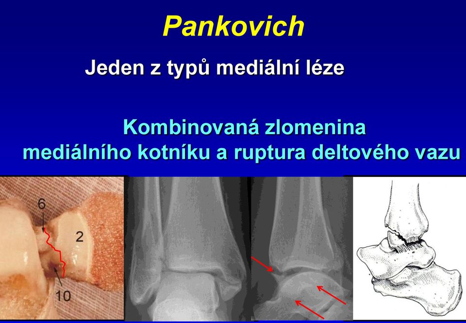 Luxační zlomeniny hlezna Nevyřešené zlomeniny - PDF Stažení zdarma