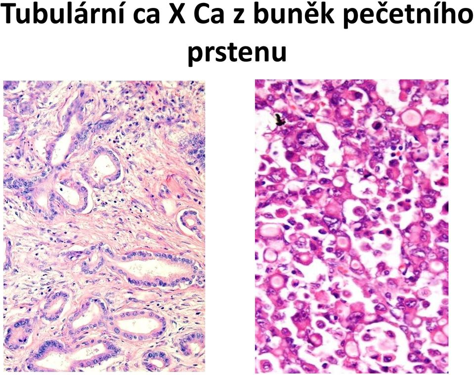 Onkopatologie Prezentace z patologické anatomie, Ošetřovatelství, 2.ročník  - PDF Stažení zdarma