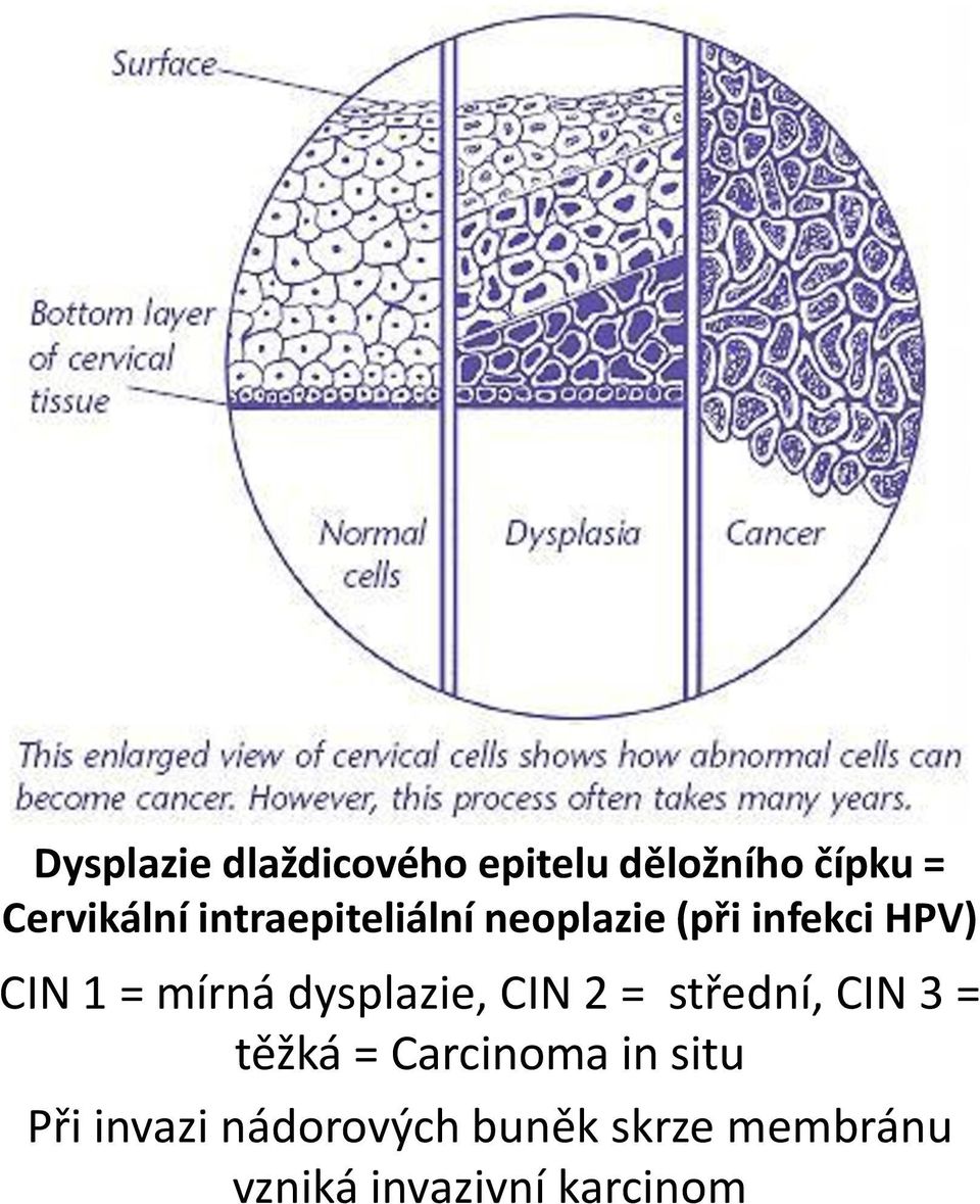 dysplazie, CIN 2 = střední, CIN 3 = těžká = Carcinoma in situ