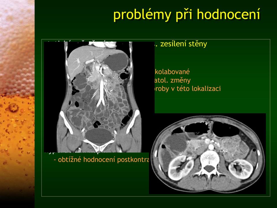 změny - málo častý výskyt Crohnovy choroby v této lokalizaci hypodenzní náplň - odlišení od cystoidních útvarů