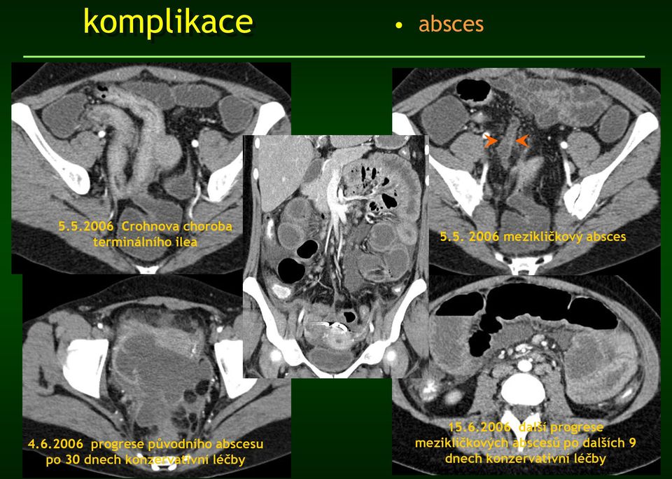 mezikličkový absces 4.6.