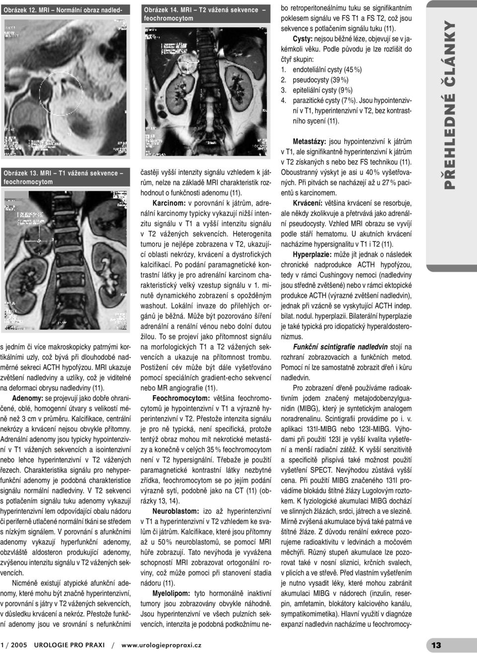 Kalcifikace, centrální nekrózy a krvácení nejsou obvykle přítomny.