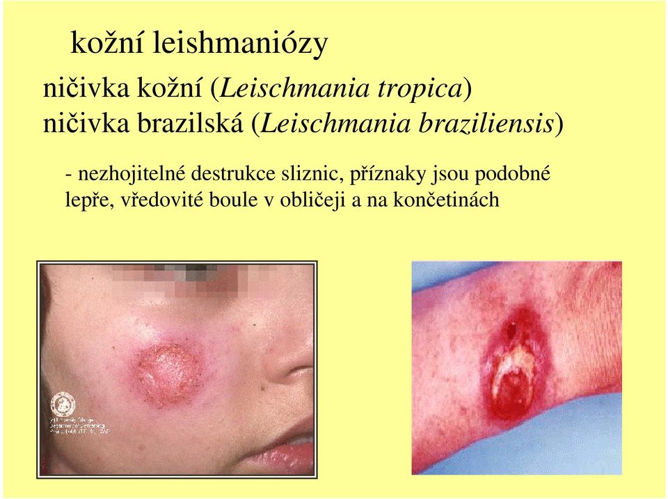 braziliensis) - nezhojitelné destrukce sliznic,