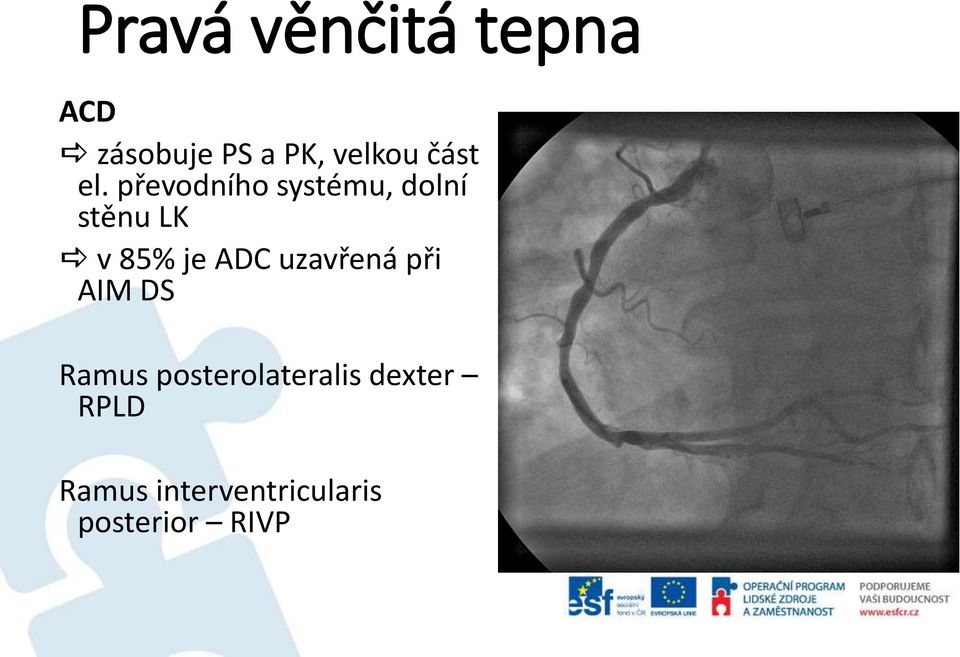 převodního systému, dolní stěnu LK v 85% je ADC