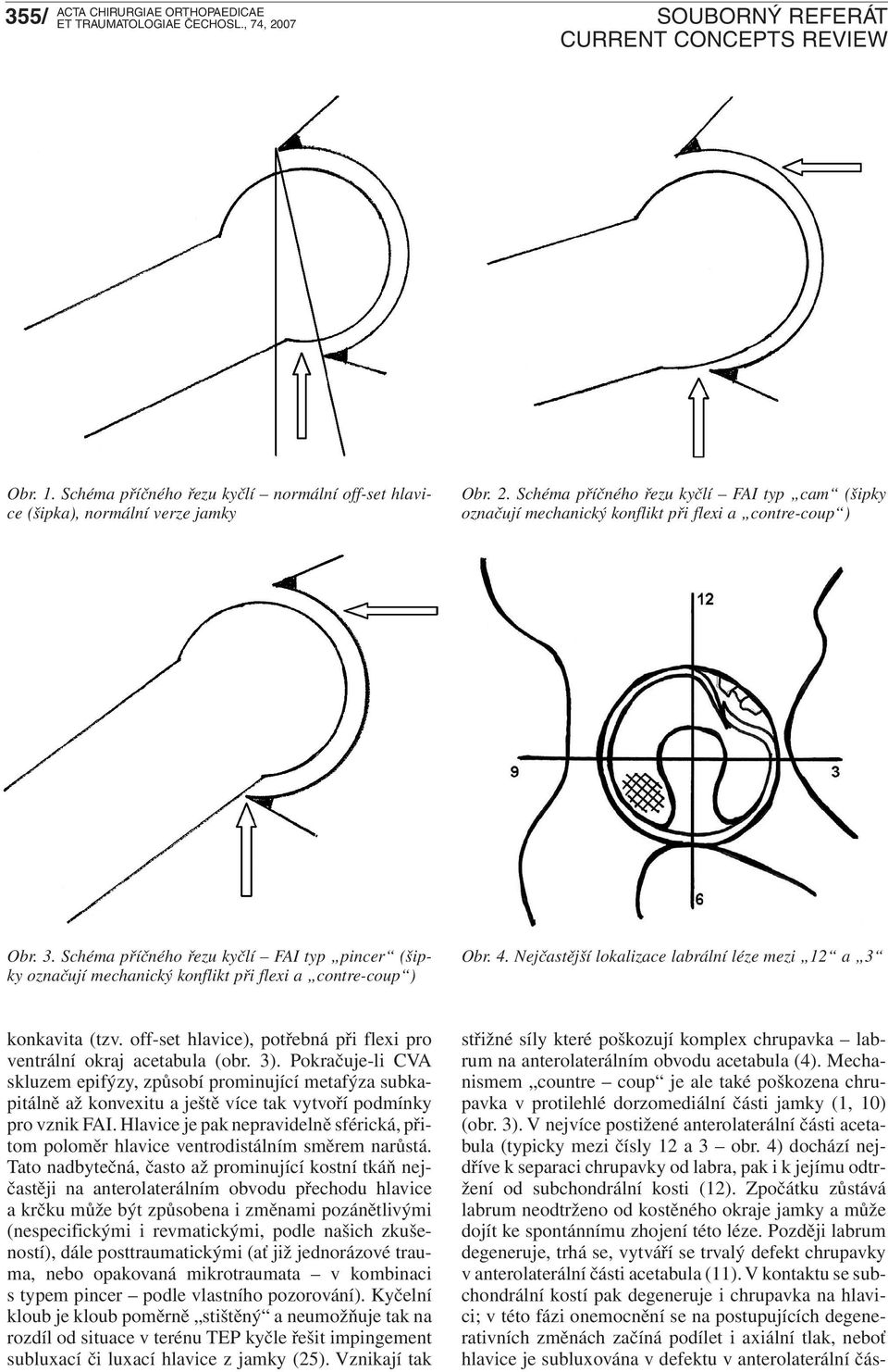 Schéma příčného řezu kyčlí FAI typ pincer (šipky označují mechanický konflikt při flexi a contre-coup ) Obr. 4.