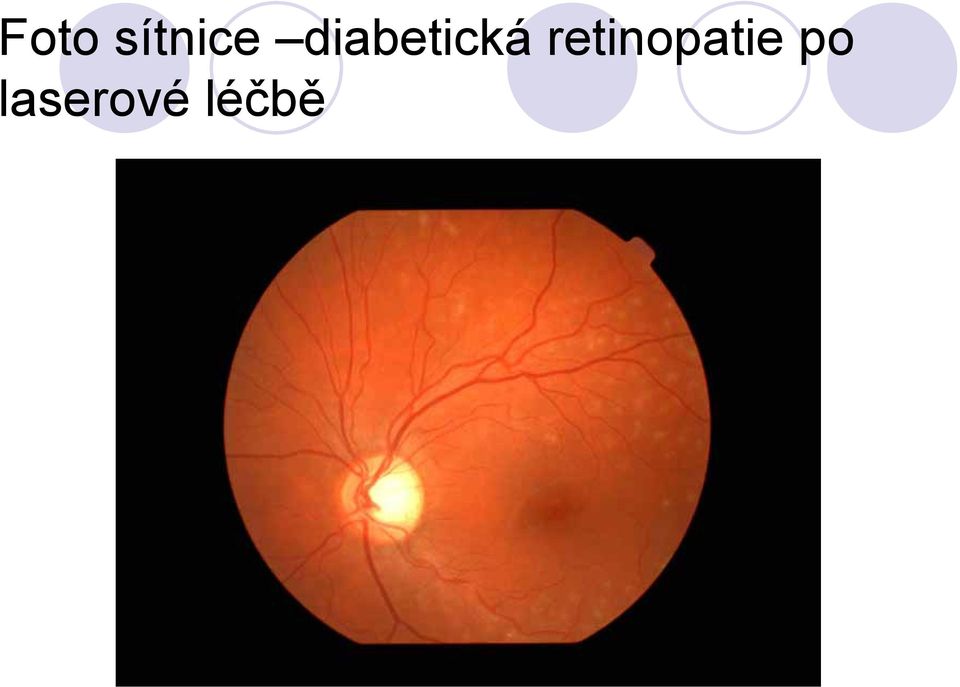 retinopatie