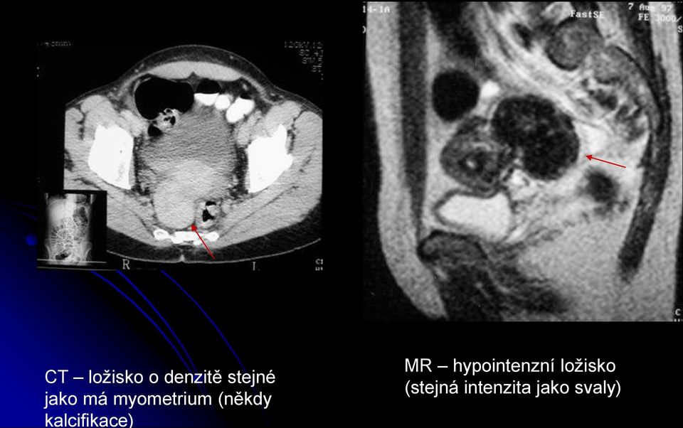 kalcifikace) MR hypointenzní