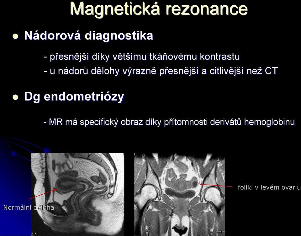 a citlivější než CT Dg endometriózy - MR má specifický obraz