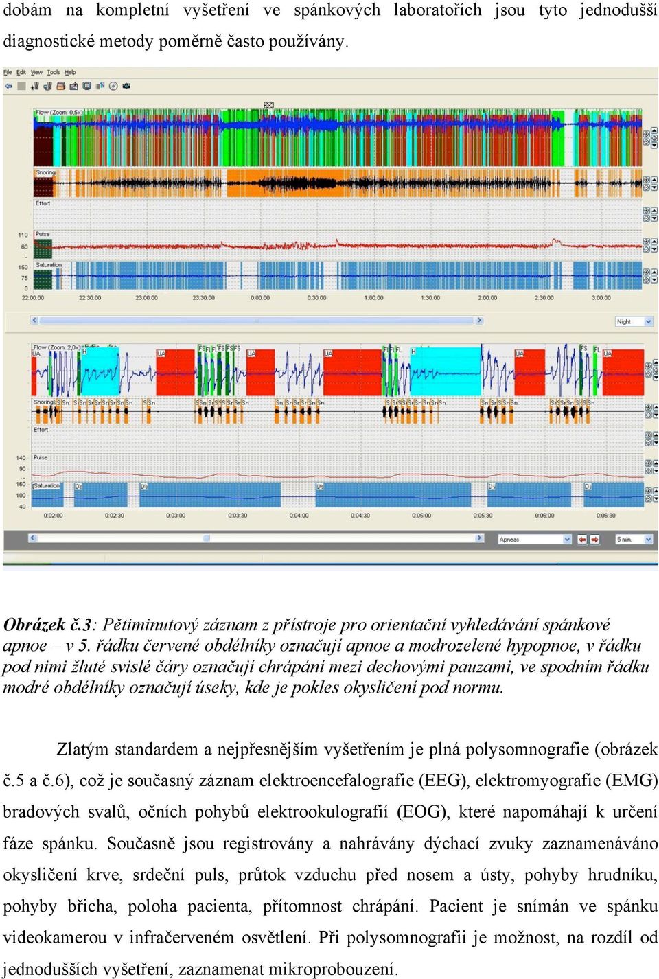 řádku červené obdélníky označují apnoe a modrozelené hypopnoe, v řádku pod nimi žluté svislé čáry označují chrápání mezi dechovými pauzami, ve spodním řádku modré obdélníky označují úseky, kde je