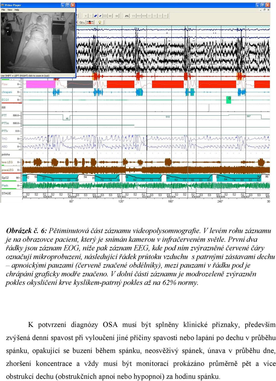 (červeně značené obdélníky), mezi pauzami v řádku pod je chrápání graficky modře značeno. V dolní části záznamu je modrozeleně zvýrazněn pokles okysličení krve kyslíkem-patrný pokles až na 62% normy.