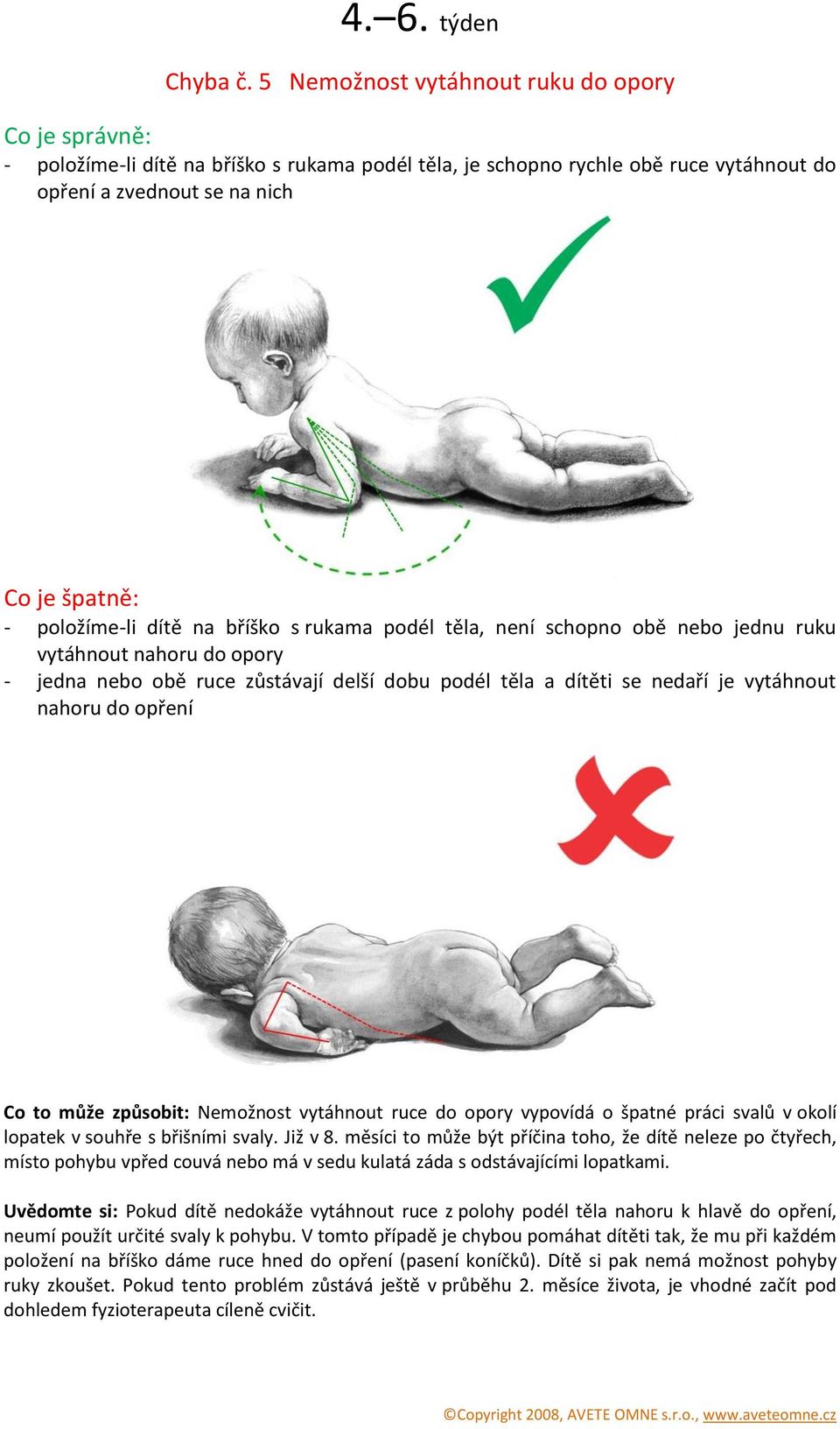 těla, není schopno obě nebo jednu ruku vytáhnout nahoru do opory - jedna nebo obě ruce zůstávají delší dobu podél těla a dítěti se nedaří je vytáhnout nahoru do opření Co to může způsobit: Nemožnost